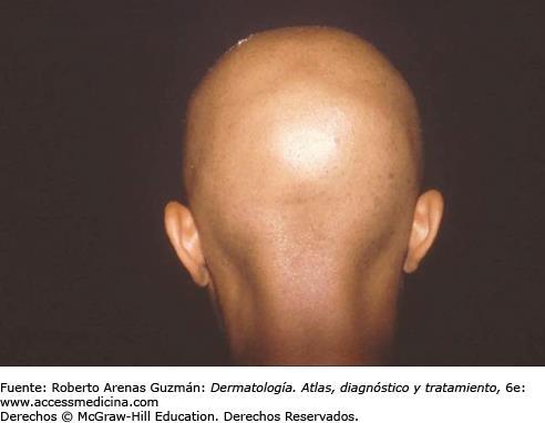 EFLUVIO ANAGÉNICO Caída brusca, difusa, intensa e incluso masiva de cabello PROCESO PATOGÉNICO 2 ó 3 días después de desencadenante (ciclo folicular detenido en anagen).