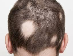 TRICOLOGÍA Alopecia androgenética