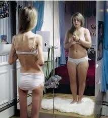Mujeres adolescentes y adultas jóvenes Trastorno de la alimentación. Anorexia.