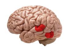 Posteriormente, debido a los problemas de lectura también desarrollan menos el área occipito-temporal izquierda (área de la forma visual de las palabras) Como consecuencia de las anomalías cerebrales