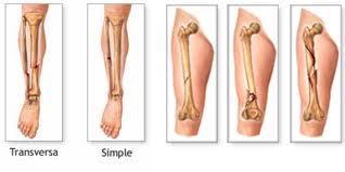 TIPOS DE LESIONES: Fisuras. Es la lesión parcial del hueso con el trazo de fractura que no toma las dos cortezas del mismo, solo lesiona una de ellas. Se forma una racha en el hueso.