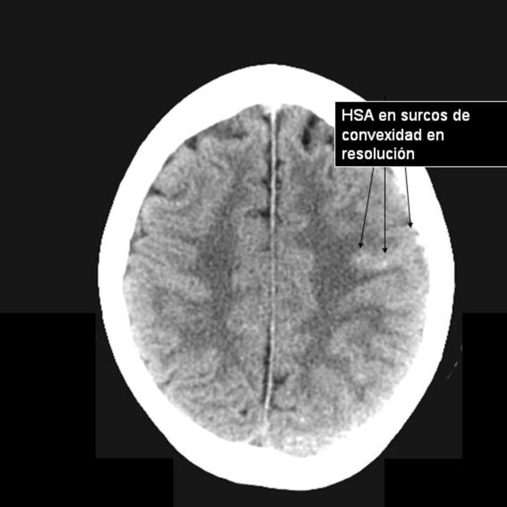 En todas las angiografías cerebrales se confirmó el diagnóstico de trombosis, así como el grado y localización que previamente se había informado en la primera exploración