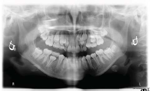nivel vestibular de los dientes 6.2 y 6.3.