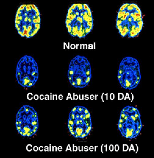 El consumo repetido de SP modifica la actividad cerebral a largo plazo Control Saludable Consumidor Cocaína (10 días de Abstinencia)