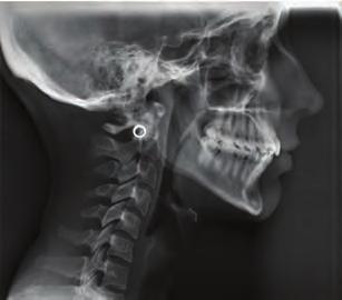 diagnóstico diferencial, a pesar de que las alteraciones biomecánicas se ponen en evidencia en la radiografía cefálica lateral.