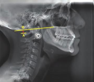 150 \ Manual de historia clínica odontológica del escolar Distancia entre la base del occipital y al arco posterior del atlas (primera vértebra cervical).