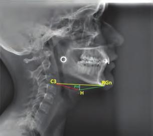 Procedimientos para el análisis radiográfico / 151 angulo craneovertebral normal= 101 +/- 5 (96-106 ) Cuando el ángulo es menor a 96 genera cambios biomecánicos como: Rotación posterior del cráneo.