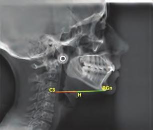 Trastornos del crecimiento mandibular y asociación a mordida tipo II. Tensión hioidea asociada a contactos oclusales posteriores.