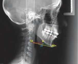 Cuando el ángulo es mayor a 106 genera cambios biomecánicos como: Rotación anterior de cráneo. Aumento espacio suboccipital. Rectificación curva cervical con verticalización de esta.
