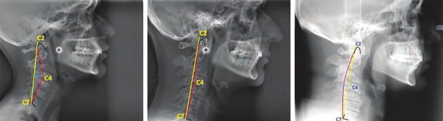 152 \ Manual de historia clínica odontológica del escolar Figura 2.20 Tipos de curvaturas vertebrales.