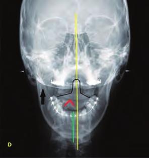 Procedimientos para el análisis radiográfico / 189 rotación vertebral, con la consiguiente alteración del movimiento de esa ATM. Una rotación del axis (ver figura 2.