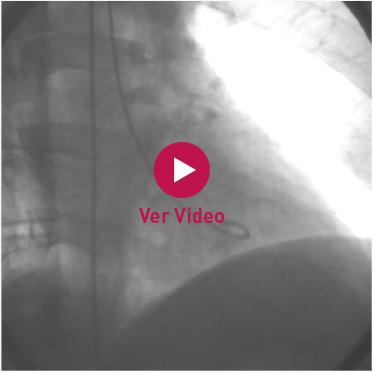 Ventriculografía En la ventriculografía realizada se puede apreciar disfunción VI