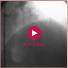 Coronariografía tras el implante del stent En la angiografía tras la revascularización, se