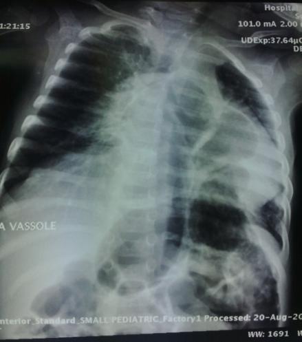 Caso clínico Lactante femenina, siete meses de edad que ingresa en el servicio de respiratorio del Hospital Pediátrico de Benguela por segunda ocasión con cuadro respiratorio agudo, dado por