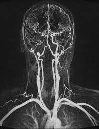 Arterias Sistema Vertebrobasilar