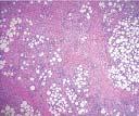 PANICULITIS MESENTÉRICA linfocítico y de células plasmáticas, miofibroblastos y acúmulos de macrófagos espumosos, con colágeno que engloba lóbulos de tejido adiposo (Figura 1).