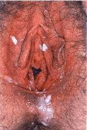 Formas clínicas Candidiasis genital Vulvovaginitis: