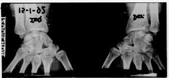 Fig. 1. Radiografía donde se diagnostica la enfermedad de Kienböck en la muñeca derecha, en estadio.iii.obsérveselaizquierdaaparentementenormal. Fig. 2. Radiografía posoperatoria AP de ambas muñecas.