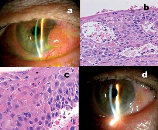 M. Pérez de Arcelus y otros Introducción La neoplasia intraepitelial conjuntivocorneal (CIN) es la tumoración más frecuente de la superficie ocular, representando el 33,4% de las lesiones epiteliales