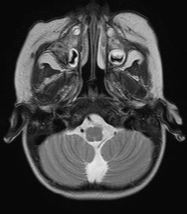 RM CRANEAL DE 14/2/17 Estabilidad radiológica del hueso maxilar derecho, con