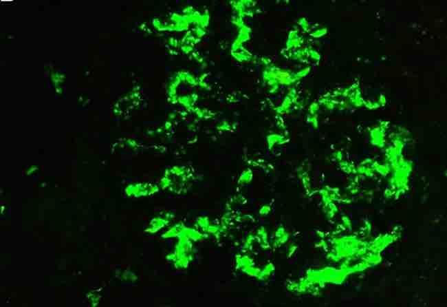 Inmunofluorescencia C3 Patrón