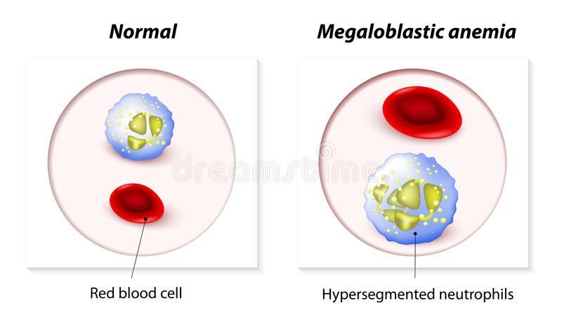Anemia macrocítica: Megaloblástica Se produce una inhibición de la síntesis de ADN en la producción de glóbulos rojos.