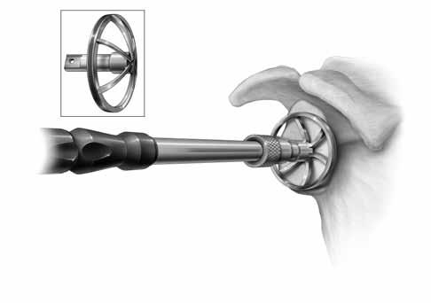 Figura 11 Conservación de hueso Defecto glenoideo Fresado angulado con implante aumentado Fresado perpendicular La aguja de Kirschner de cero grados y la guía de alineación de aguja de Kirschner para