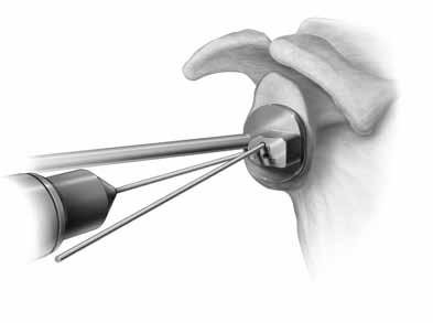 Figura 4 Conservación de hueso Defecto glenoideo Fresado angulado con implante aumentado Fresado perpendicular Nota: se aplican 8º de angulación para fresar en sentido excéntrico la glena con el fin