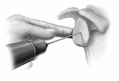 Si el paciente tiene desgaste superior y un desgarro irreparable del manguito de los rotadores, y el cirujano desea corregir la glena recolocándola en inclinación neutral, existen las siguientes