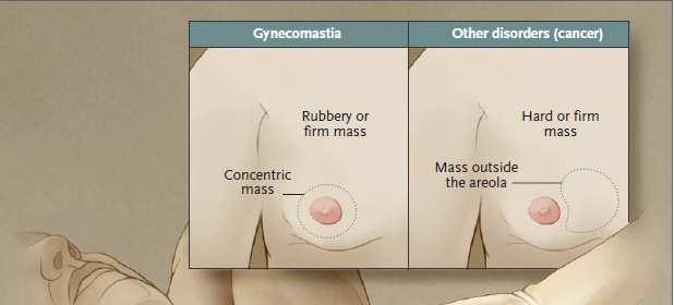 Examen físico Glándula mamaria Ginecomastia vs pseudoginecomastia Signos