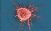 CCM: PATOGÉNESIS En 2008 se identificó poliomavirus de células de Merkel (MCPyV) factor contribuyente en la patogénesis del CCM.
