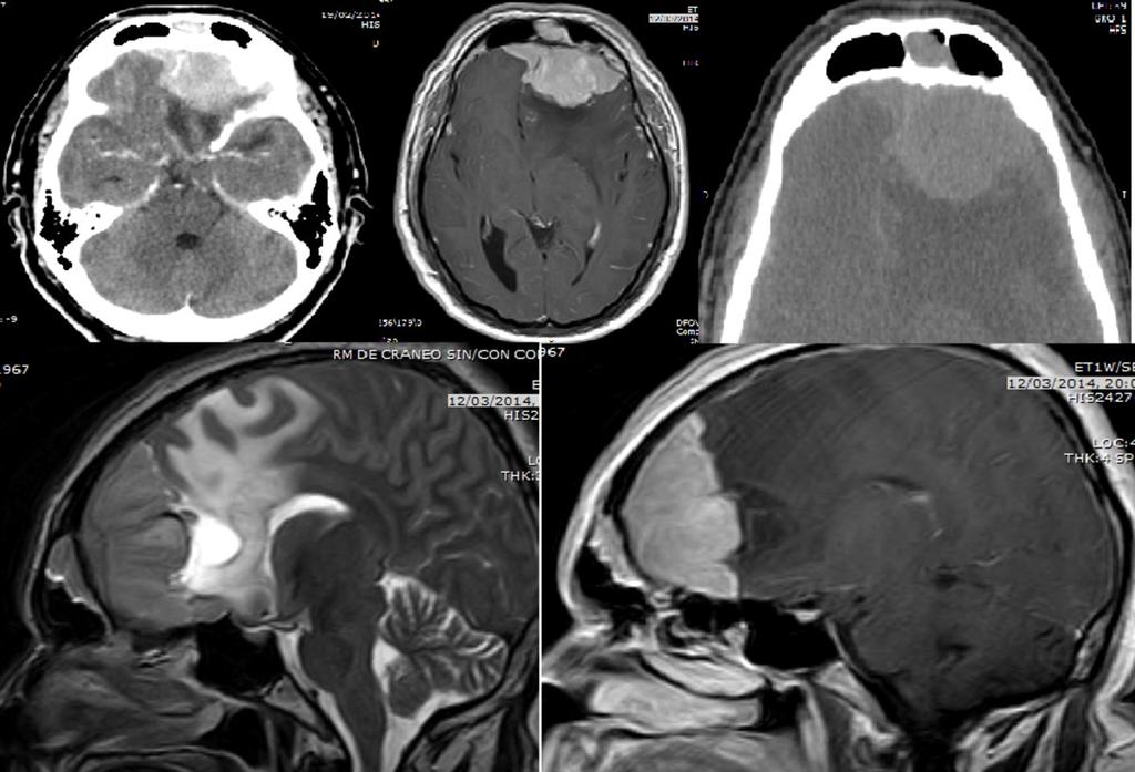 Fig. 14: Cortes axiales de TC y RM craneales, visualizandose meningioma frontal izquierdo. En cortes sagitales de RM se aprecia quiste aracnoideo acompañante.