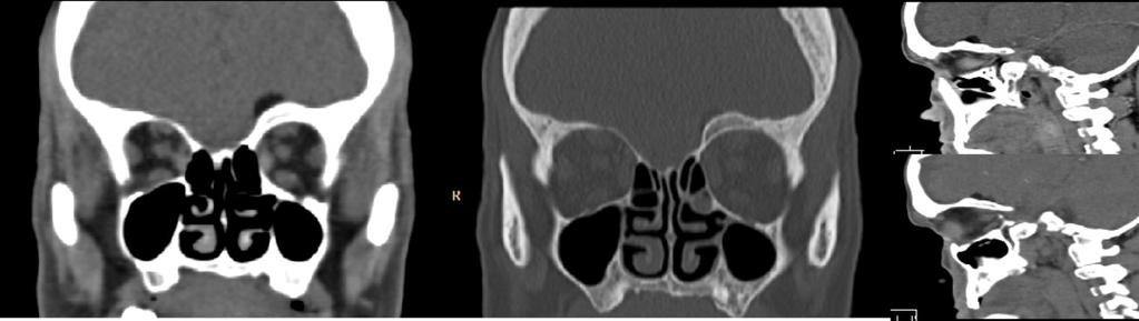 Fig. 18: TC de craneo, cortes coronales y sagitales en ventana ósea.