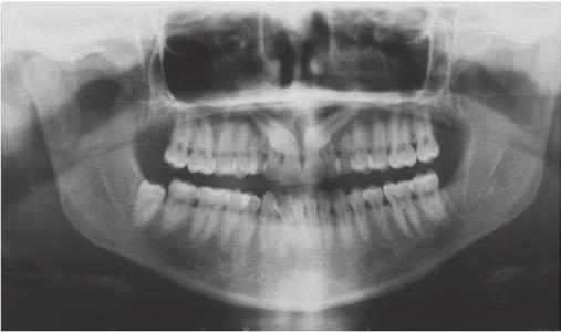 molares superiores para la colocación de elásticos en Z, inicialmente de 5/16 y 2,5 onzas, para eliminar la mordida cruzada posterior
