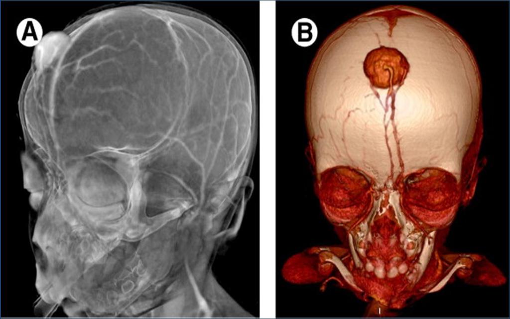 los síntomas son infrecuentes; pueden asociarse a cefalea crónica las imágenes permiten