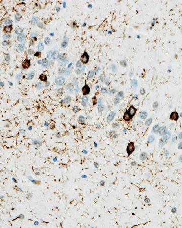 astrocitos tau+), así como otras lesiones inespecíficas (neuronas balonizadas).