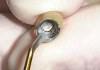 Asentar la unidad pilar-corona en la cavidad conectora del implante.