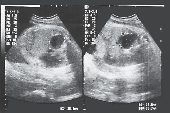 3.500 g con diagnóstico prenatal de Masa Pulmonar (MP).