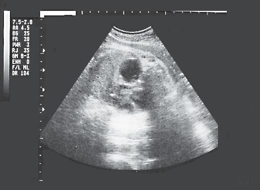 retrocardíaca con diafragma aparentemente intacto de 27 por 31 por 26 mm. que no compromete la vitalidad fetal (Figura 1 y 2).
