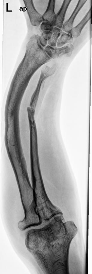 Figura A la exploración presentó una importante deformidad en antebrazo izquierdo con una curvatura radial muy pronunciada y atrofia de la musculatura intrínseca de la mano izquierda junto con un
