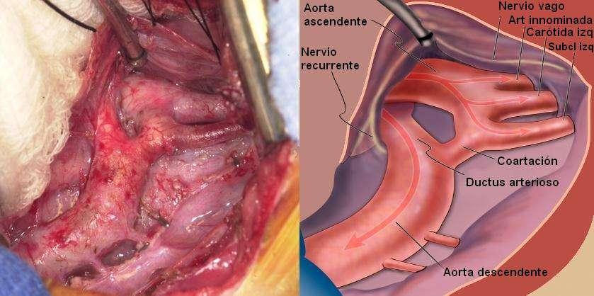 Entre las más frecuentes se encuentran el Ductus Arterioso Persistente, la Válvula Aórtica Bicúspide, la Comunicación Interventricular (CIV) y anomalías de la válvula mitral.