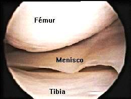 COMPONENTES DE LA ARTICULACION MENISCOS (RODILLA): Fibrocartílago fijado en la tibia de forma semilunar.