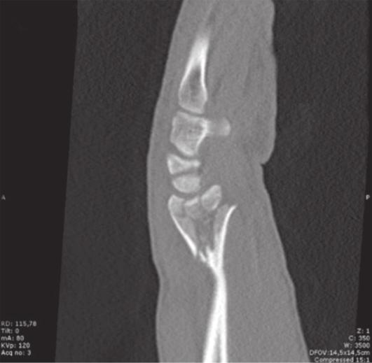 Paciente de 43 años con fractura intra-articular conminuta de radio distal izquierdo y conminución metafisaria por caída de 4 metros.