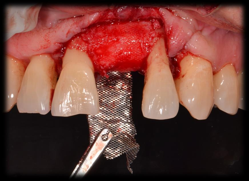 Retiro de Malla de Titanio después de 4 meses de cicatrización Se realiza una incisión en la zona del diente 21 cargada a hacia palatino y se sigue el contorno de los