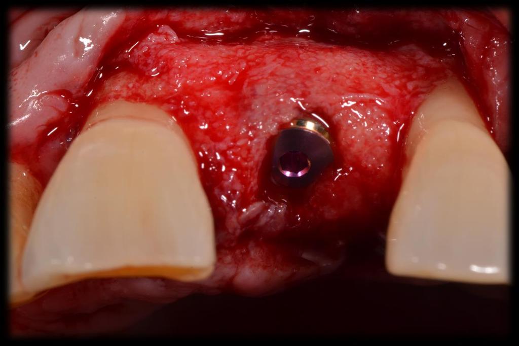 Figura 10. Vista incisal del implante colocado con tornillo de cierre.