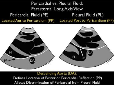 Derrame pericárdico vs derrame pleural El diagnós>co se realiza valorando la relación del derrame con la aorta