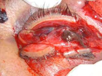 Trauma Penetrante en Ojo Protección ocular rígida para lesiones en ojo evidentes o sospechadas.