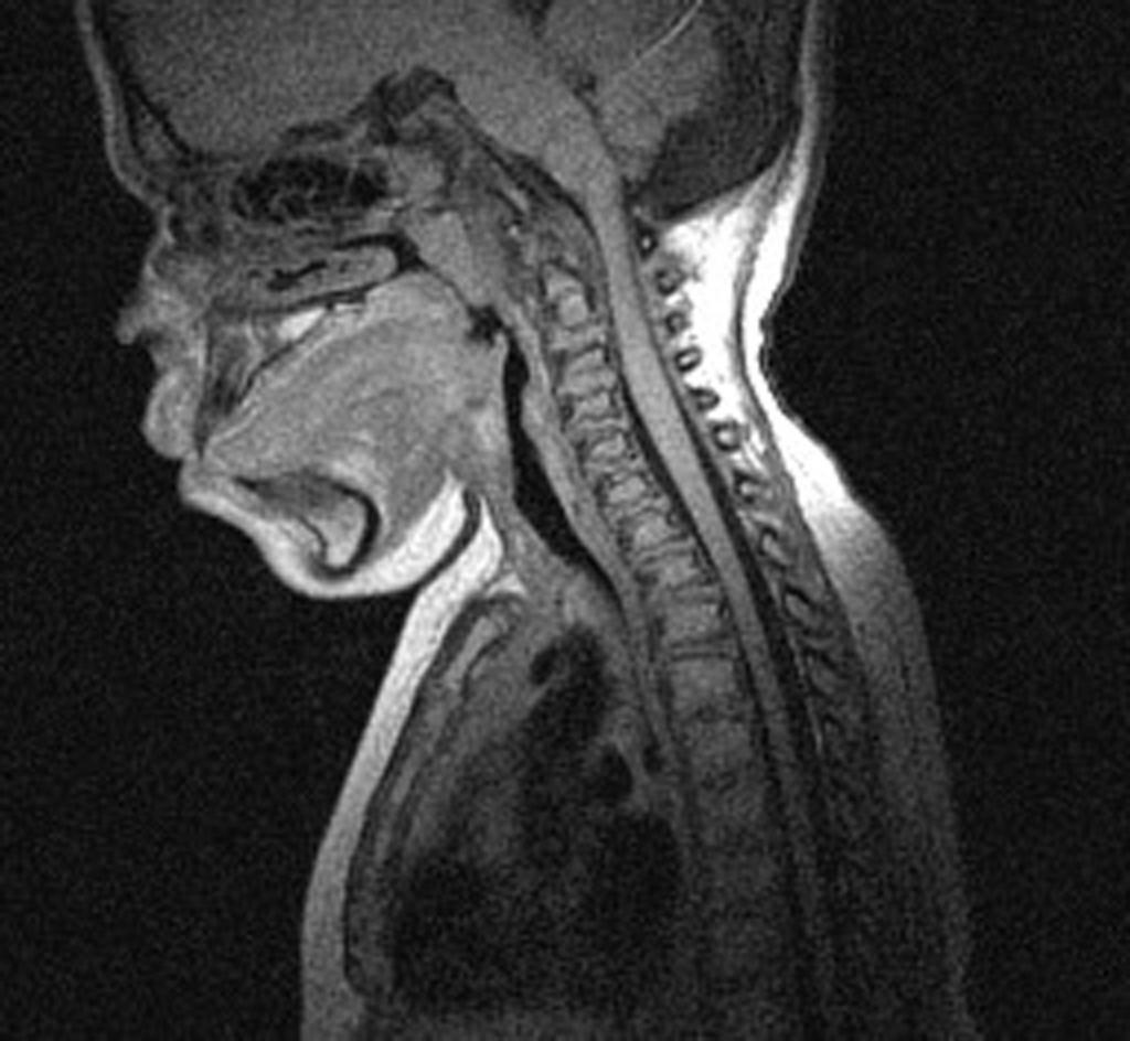Fig. 18: Imagen axial de RM de cráneo. Secuencia FLAIR: Zonas hiperintensas bilaterales en sustancia blanca. Fig.