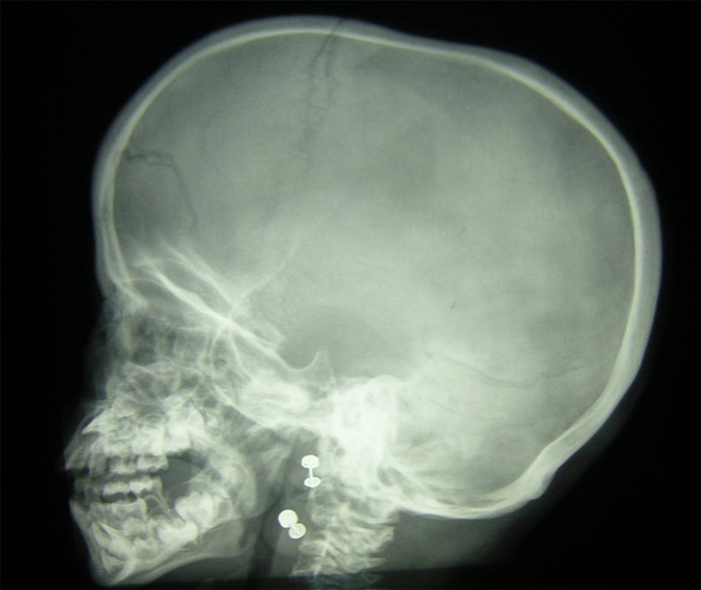 Fig. 1: Radiografía lateral de cráneo: Cráneo grande con