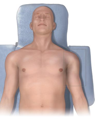 Técnica quirúrgica de la placa para el húmero proximal Polarus Figura 1 1 Colocación del paciente Coloque al paciente en posición en «silla de playa» con el brazo